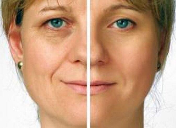piel alrededor de los ojos antes y después del rejuvenecimiento